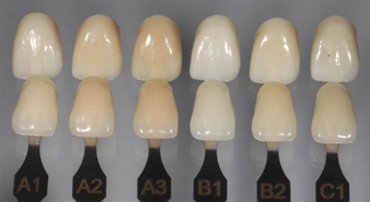Abb. 1: Monolithische Zirkoniumdioxid-Kronen (Zenostar, Wieland Dental) im Vergleich zum VITA Farbschlüssel