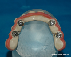 Verschraubbare Implantat-Suprastruktur aus JUVORA PEEK