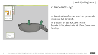 2. Implantat-Typ